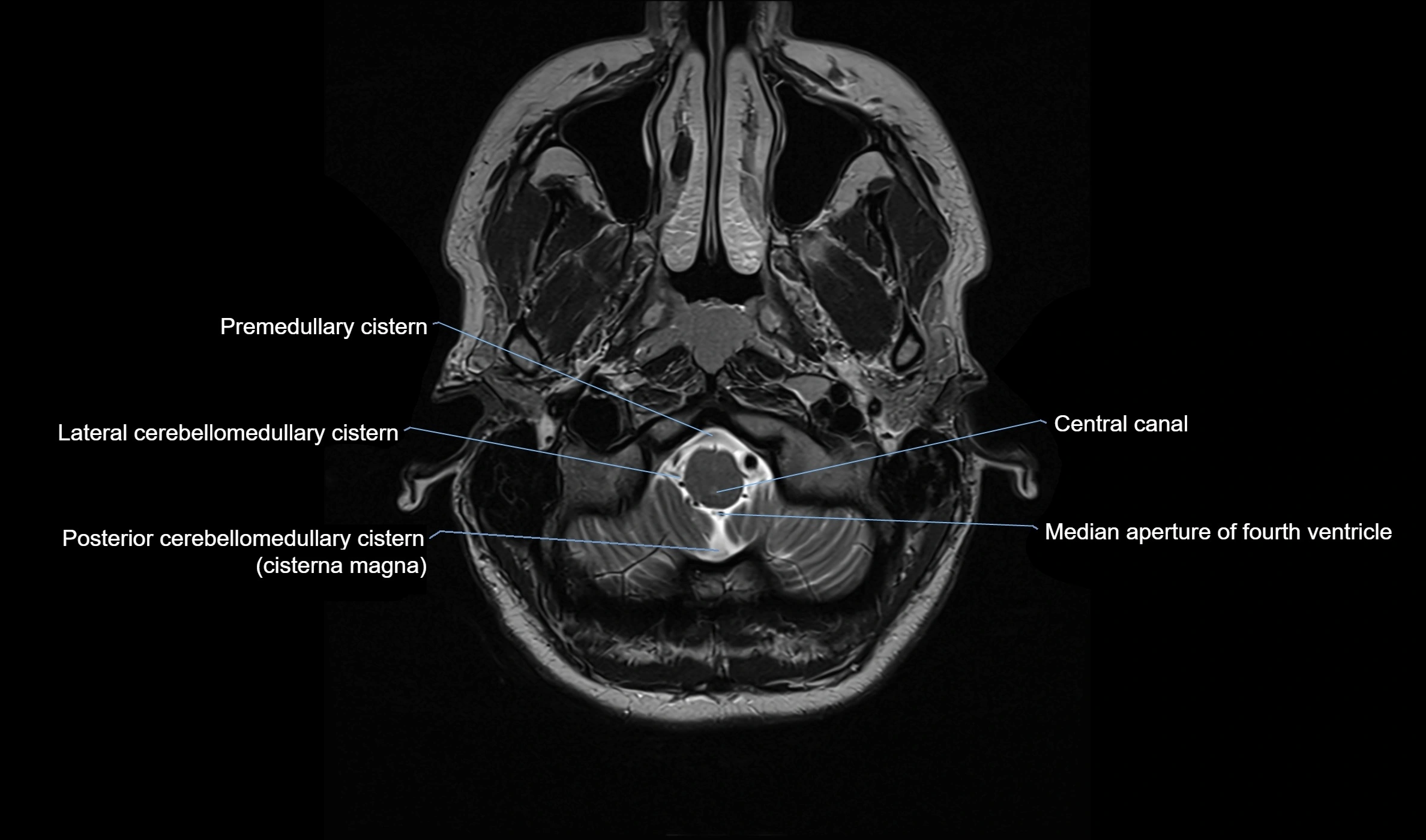 Brain cisterns  and ventricles  axial anatomy 3T MRI image-img-00001-00003.webp